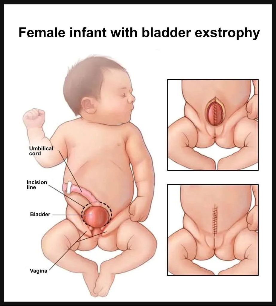 Bladder Exstrophy Diagnosis