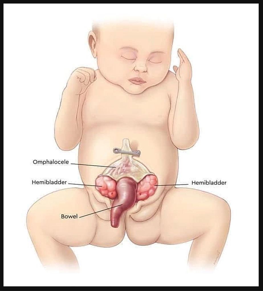 Bladder Exstrophy Diagnosis